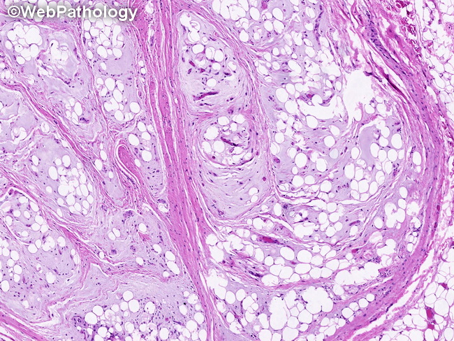 Soft Tissue_Lipomatous_Lipoblastoma15_resized.jpg